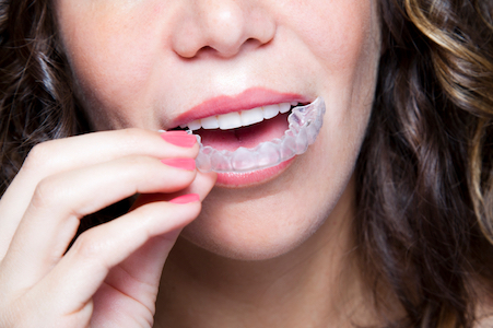 woman putting in invisalign clear aligners. 