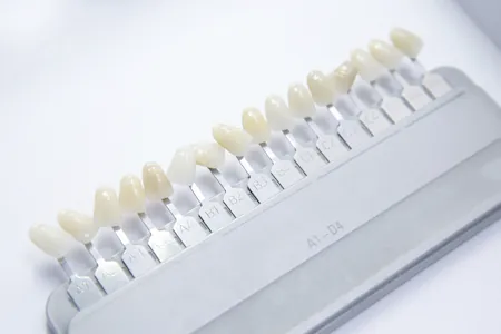 dental veneers used to match tooth color