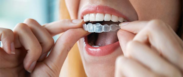 Invisalign clear aligners