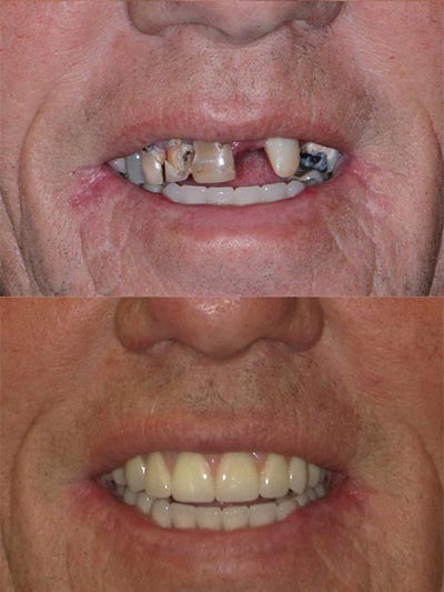 patient receiving all-on-4 dental implants from Warren & Hagerman Family Dentistry