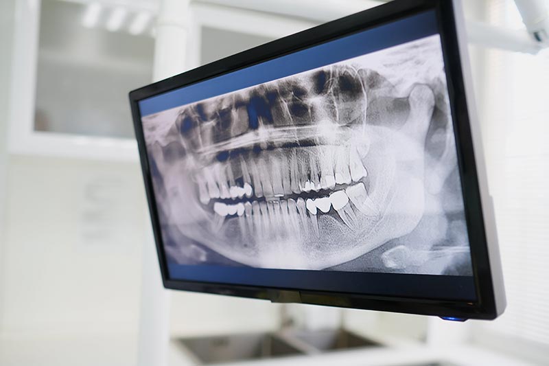 Panoramic dental X-ray on a monitor